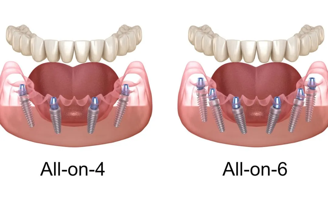 All-on-4 and All-on-6 Dental Implants in York, Maine