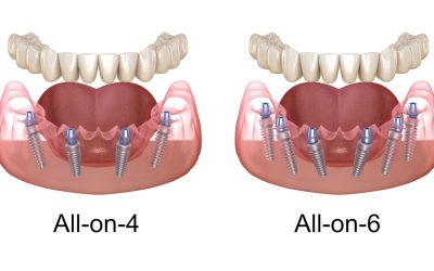 All-on-4 and All-on-6 Dental Implants in York, Maine