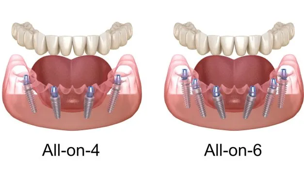 All-on-4 and All-on-6 Dental Implants in York, Maine