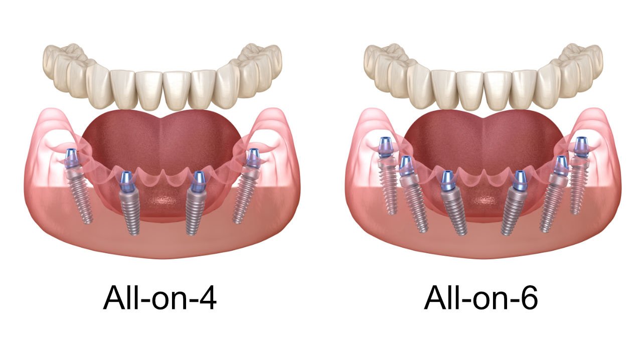 All-on-4 and All-on-6 Dental Implants in York, Maine