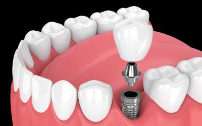 Are Dental Implants Right for Me? An In Depth Review