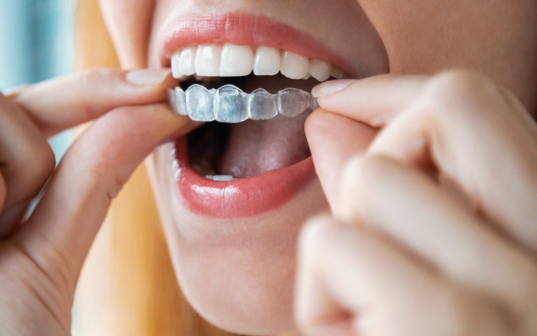 Clear Aligners: What Are They? How Do They Work?