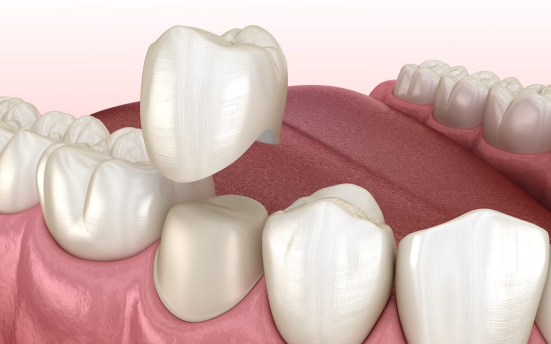 Same-Day Crowns – Podcast