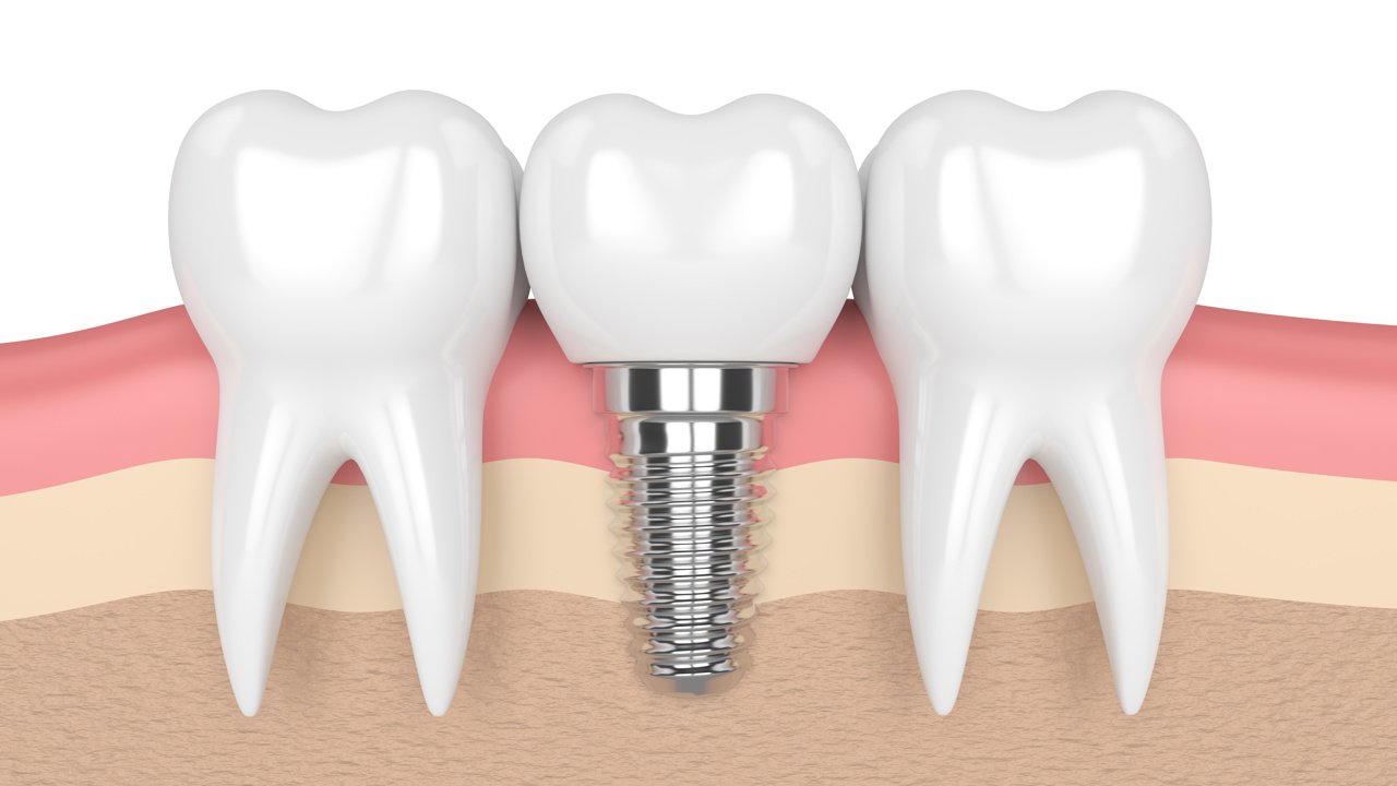 Dental Implant - York Village Dental
