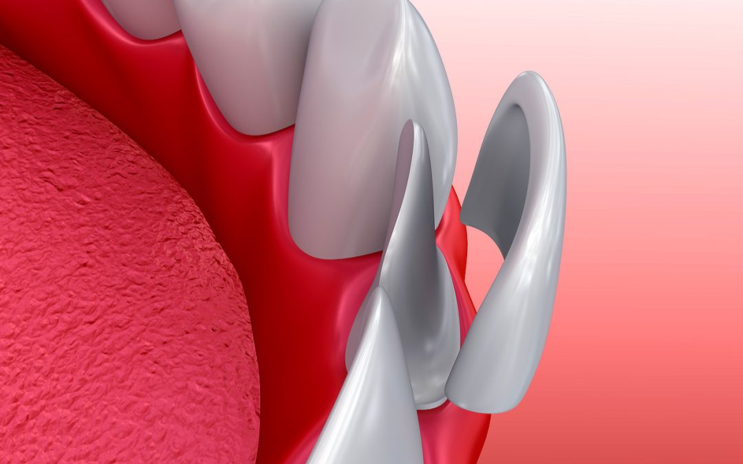 A Patient’s Guide to Dental Veneers