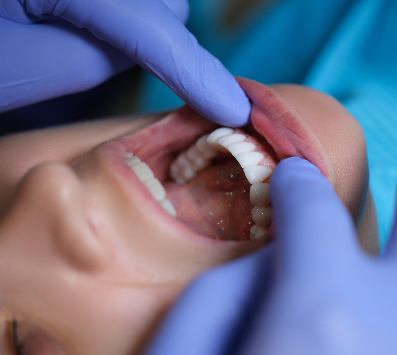 Dental Veneers York Village Dental