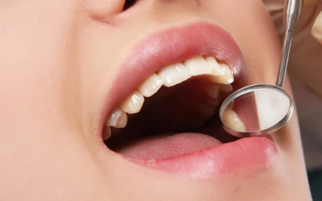 Everything You Need to Know About Tooth Extractions