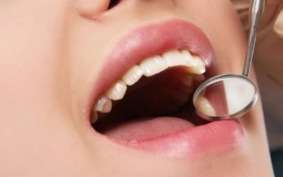 Everything You Need to Know About Tooth Extractions
