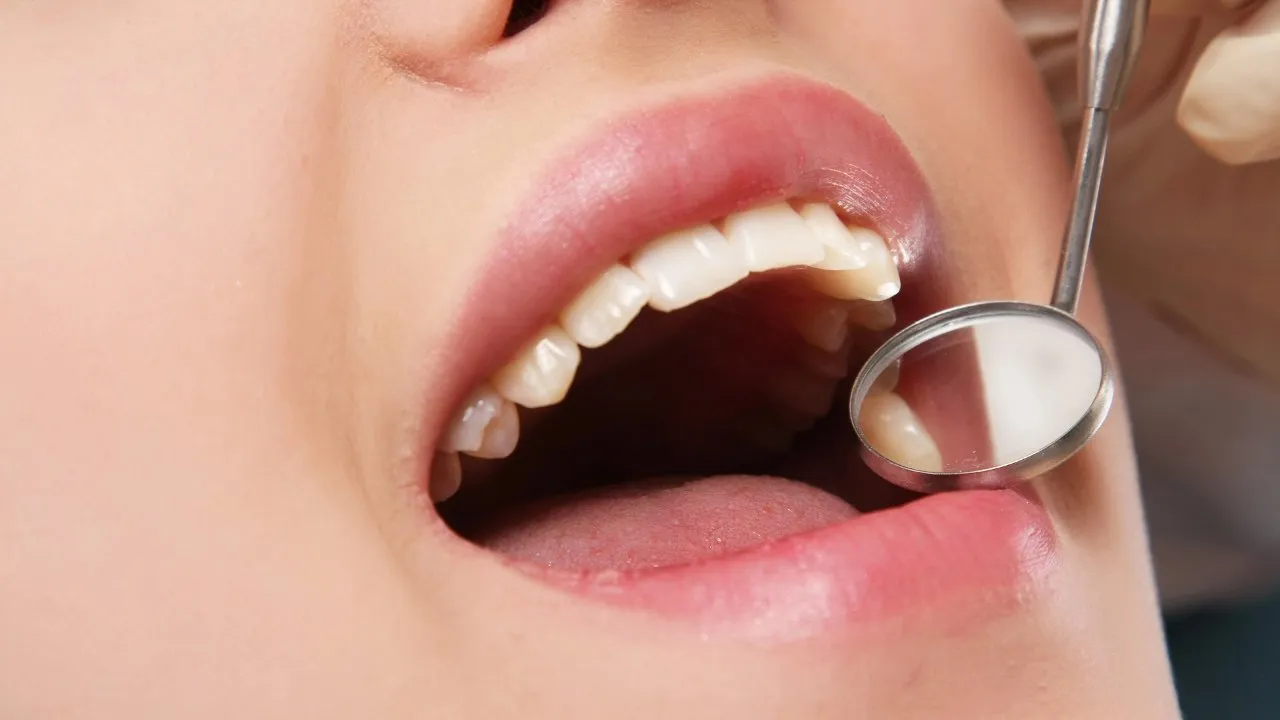 Everything You Need to Know About Tooth Extractions