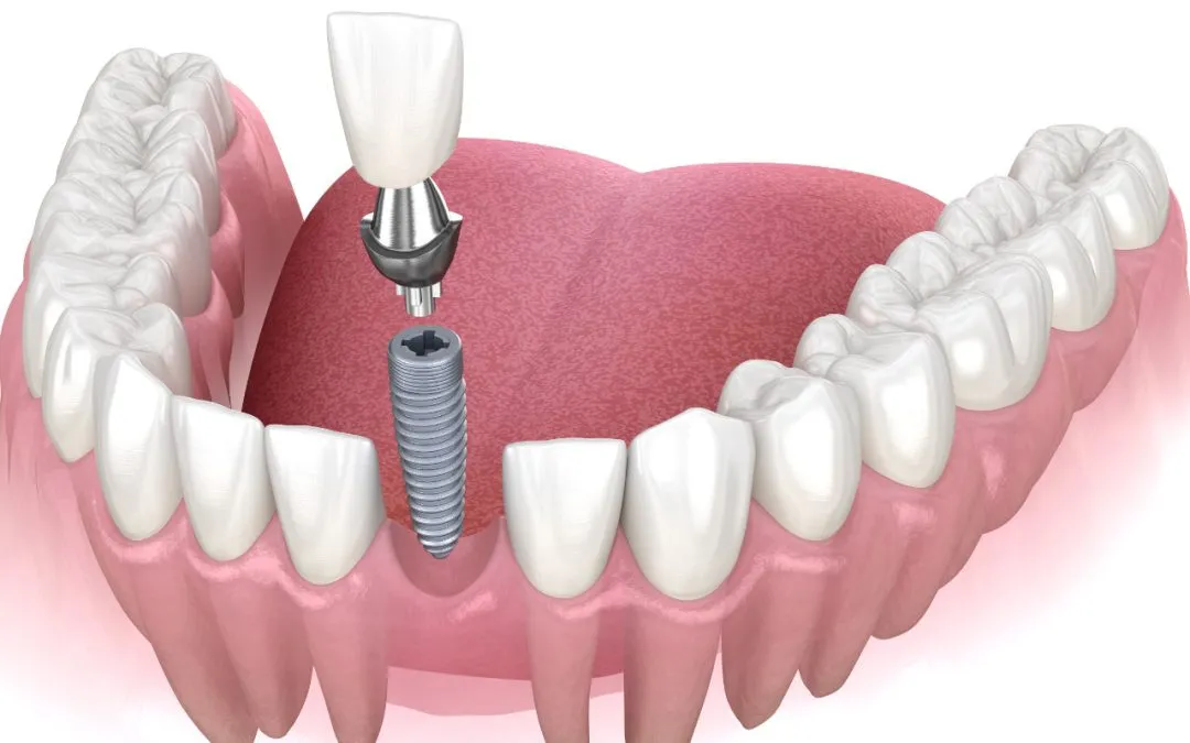 Front Tooth Dental Implants - York Village Dental