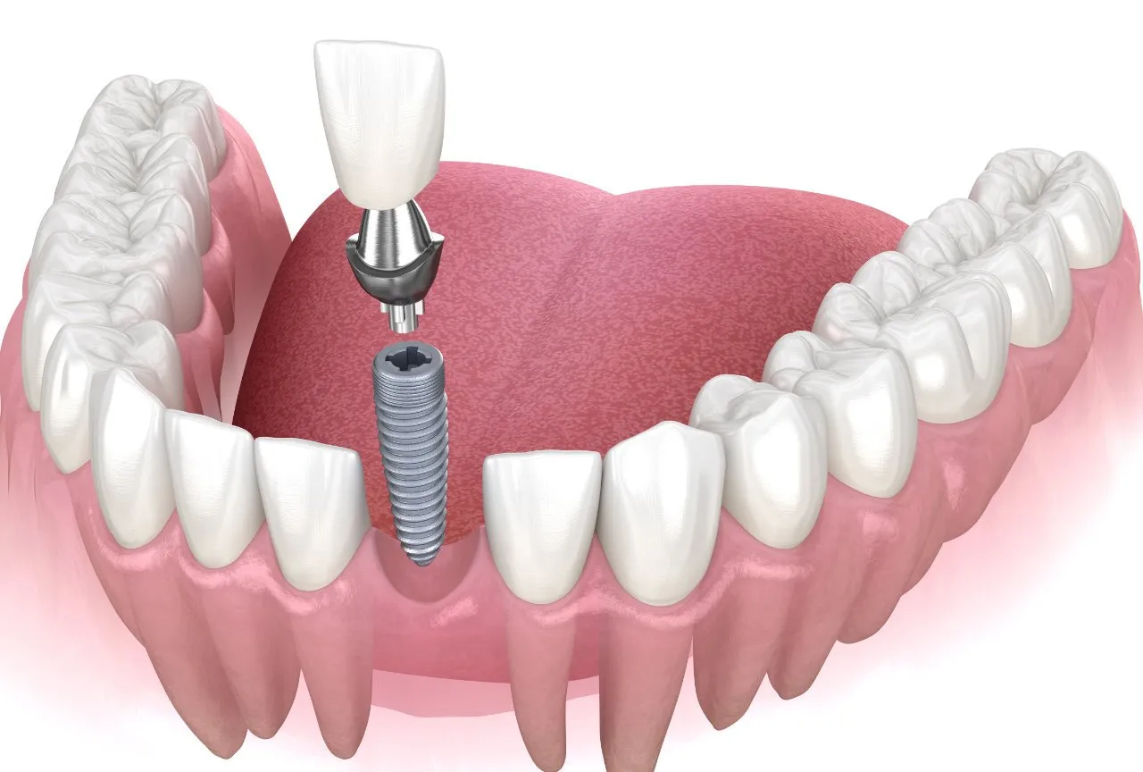 Front Tooth Dental Implants - York Village Dental