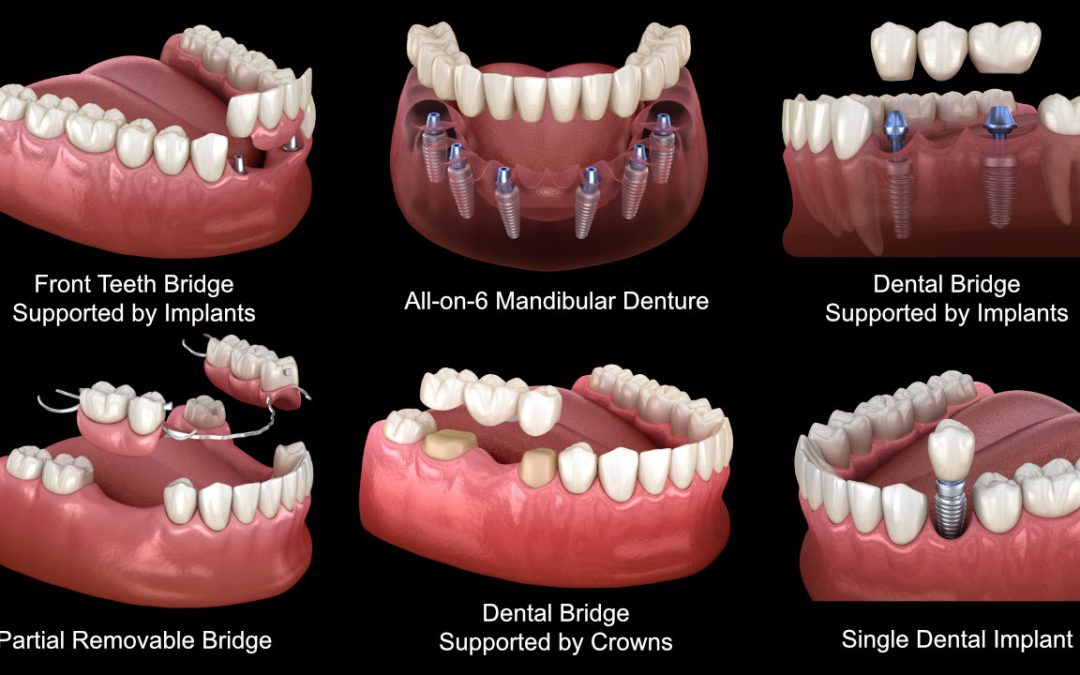 Teeth Replacement Options - York Village Dental