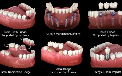 Restore Your Smile: Tooth Replacement Options After Extraction