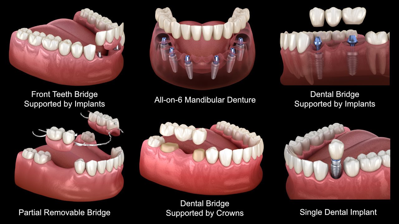Teeth Replacement Options - York Village Dental