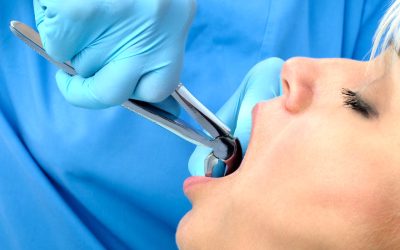 A Patient’s Guide to Tooth Extraction